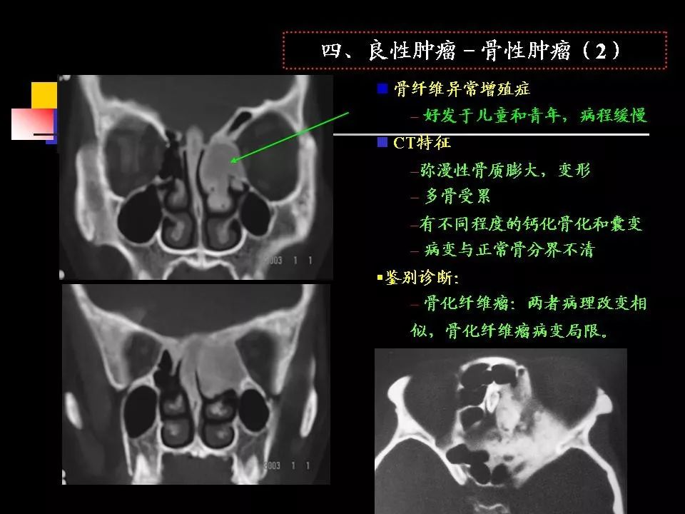 鼻腔鼻竇的ct解剖及該區域常見疾病的影像學診斷影像天地