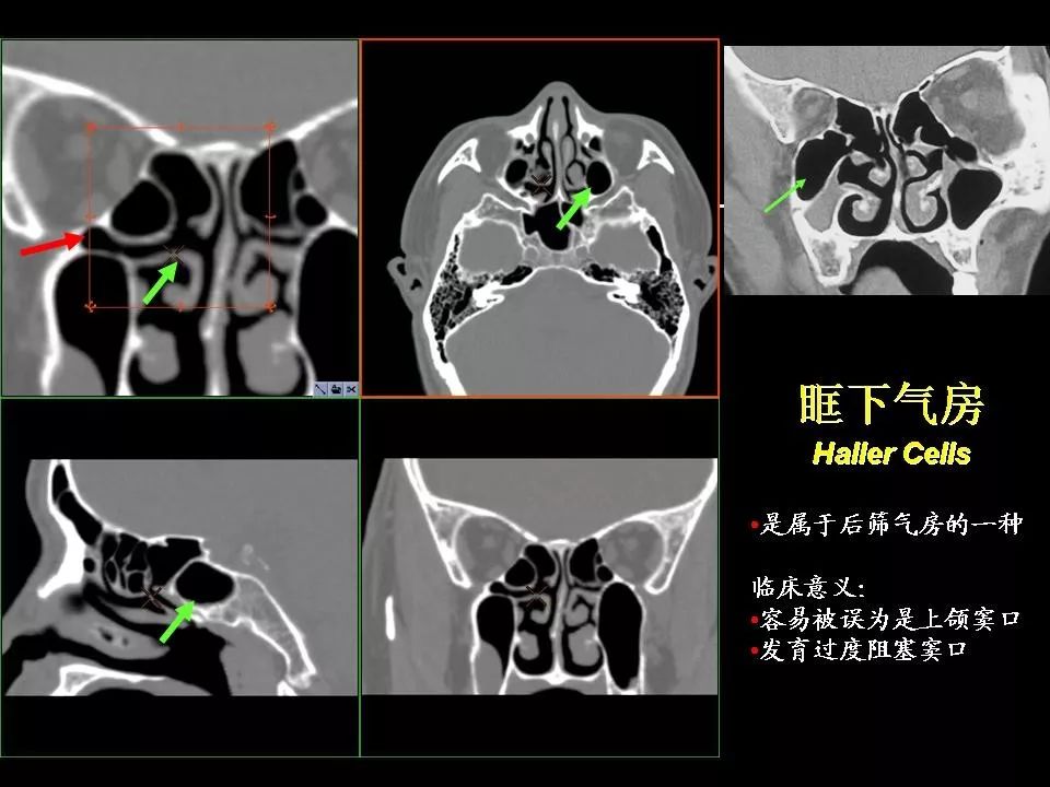 鼻腔鼻窦的ct解剖及该区域常见疾病的影像学诊断影像天地