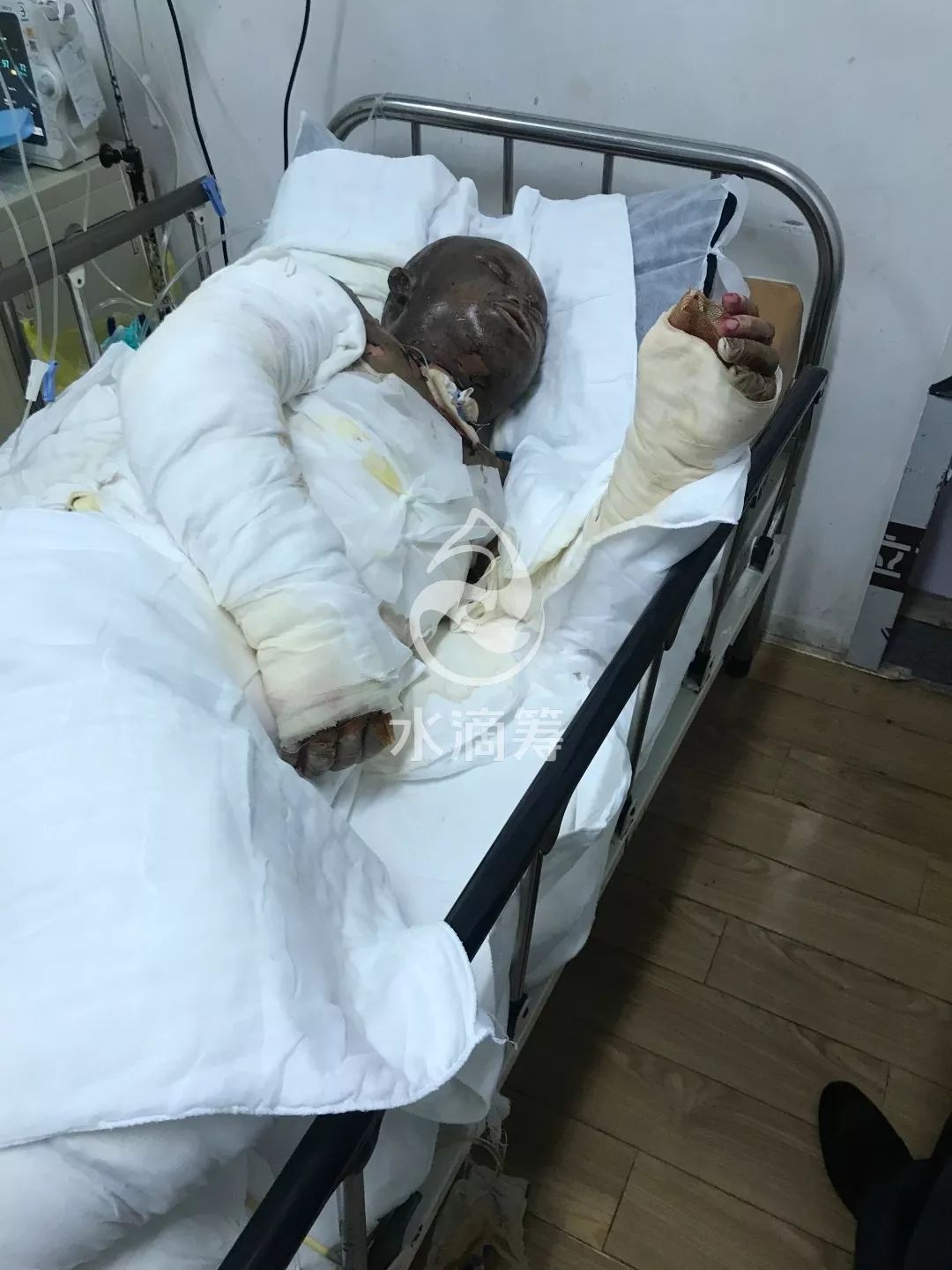 紧急求助救救这位潍坊父亲煤气爆炸全身烧伤面积90