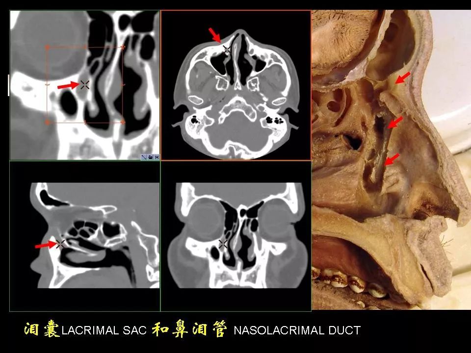 鼻腔鼻竇的ct解剖及該區域常見疾病的影像學診斷影像天地