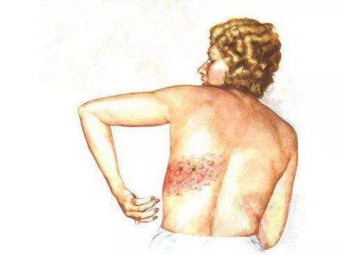 民间传言被"缠腰龙"缠上一圈会死人,对此高宝良医师解释:"带状疱疹