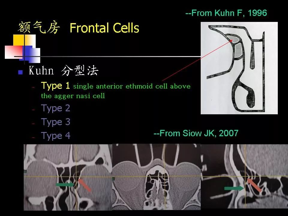 鼻腔鼻竇的ct解剖及該區域常見疾病的影像學診斷影像天地