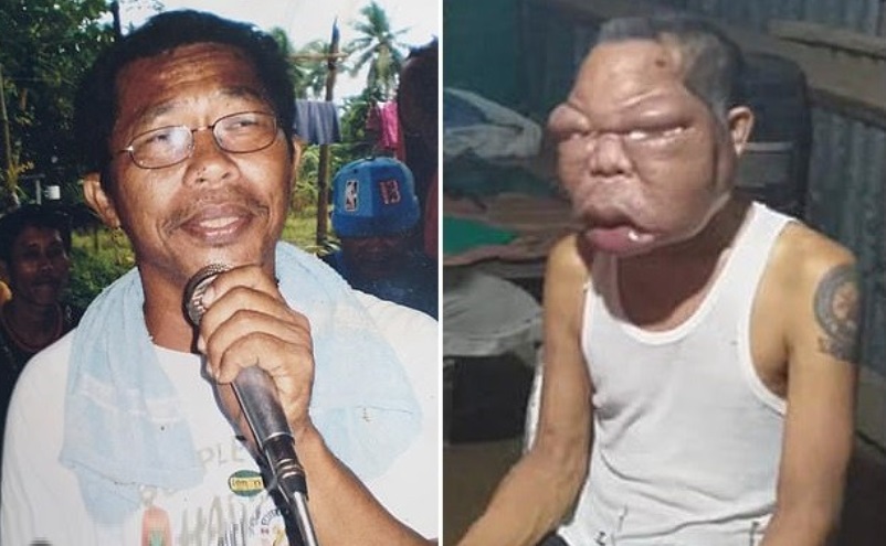 一名外国男子由于神秘疾病脸部肿大变得犹如漫画中的人物