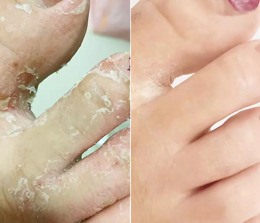 一到夏天,身上发痒过敏,用它洗洗,皮炎湿疹全好了!