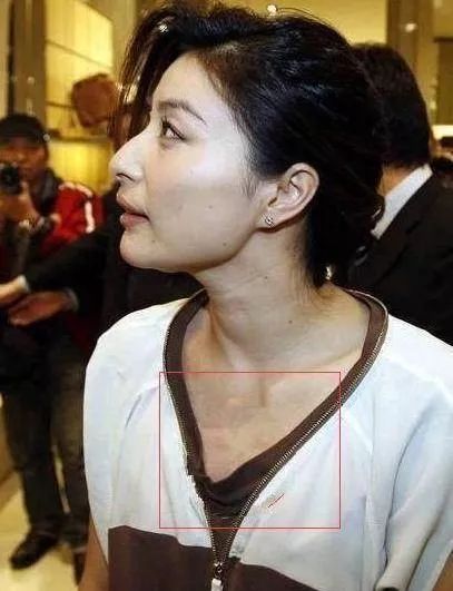 郭晶晶终于穿得像个豪门贵妇了不过网友却盯着她胸口的淤青不放