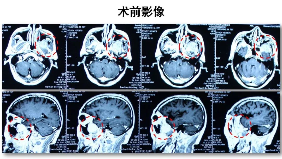 正海妙術視界丨趙天智副教授筷子技術經鼻淚前隱窩入路切除翼顎窩顳下