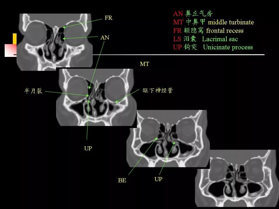 鼻腔,鼻窦的ct解剖及该区域常见疾病的影像学诊断 
