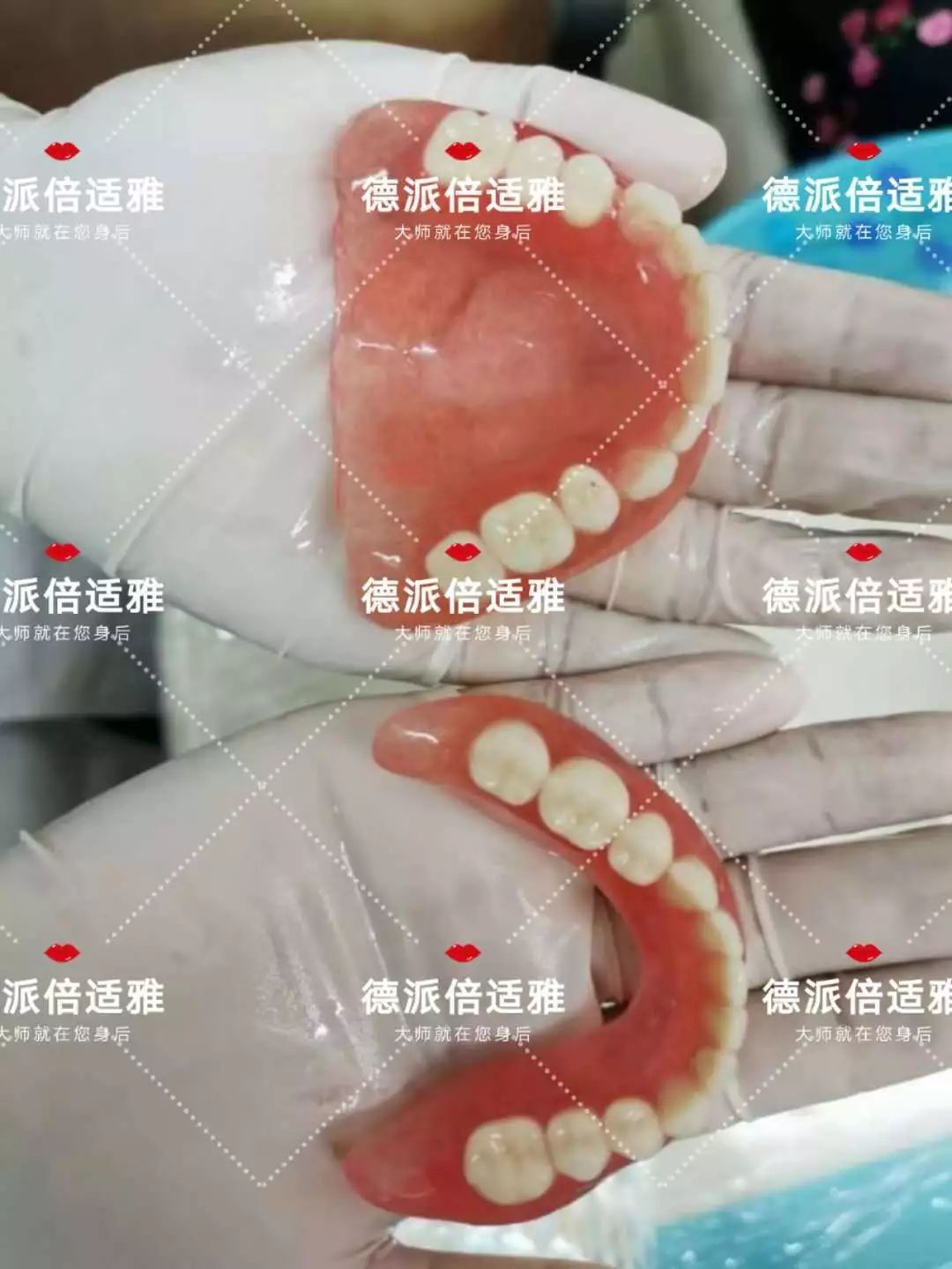 德派倍適雅全口義齒採用中性區取模排牙技術 飛鷹5s多層色樹脂牙