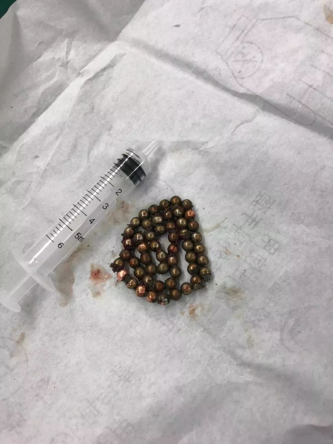 01膀胱异物,顾名思义,就是膀胱里出现除了尿以外的其他东西,钢珠,钢