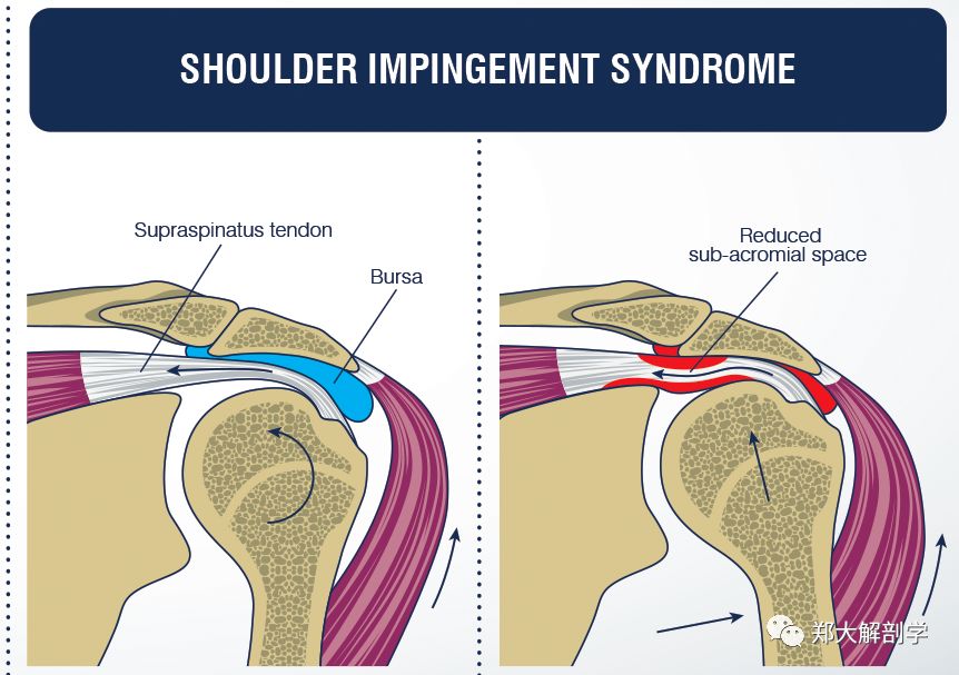 疼痛时,将肩外旋继续上抬,疼痛减轻或消失为阳性提示:肩峰撞击综合症