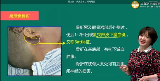 多在伤后1912日出现耳后乳突部皮下淤血斑(battle征)