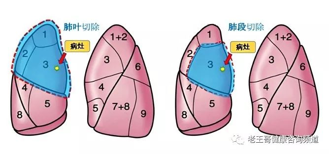 肺下界移动度 来自搜狐网