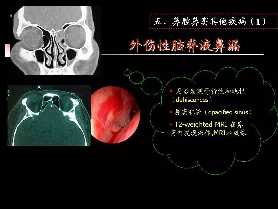 鼻腔鼻竇的ct解剖及該區域常見疾病的影像學診斷影像天地