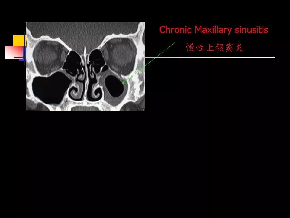 鼻腔鼻窦的ct解剖及该区域常见疾病的影像学诊断影像天地