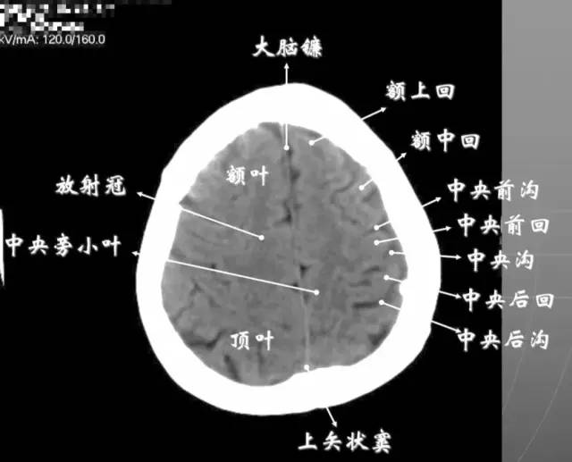 左侧额窦内外侧壁骨折▲左侧颞骨骨折2硬膜外血肿▲硬膜外血肿,颅内积