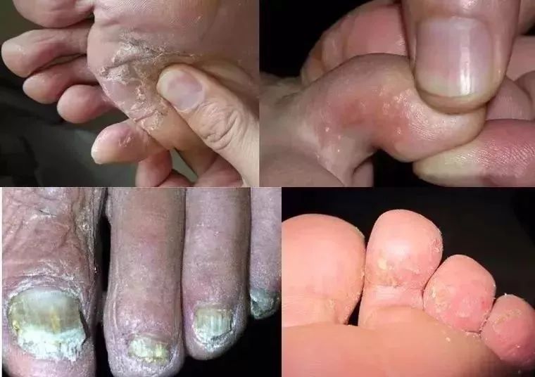 一系列让你觉得心烦的症状蜕皮,长水疱,灰指甲等滋生癣菌,诱发脚气,脚