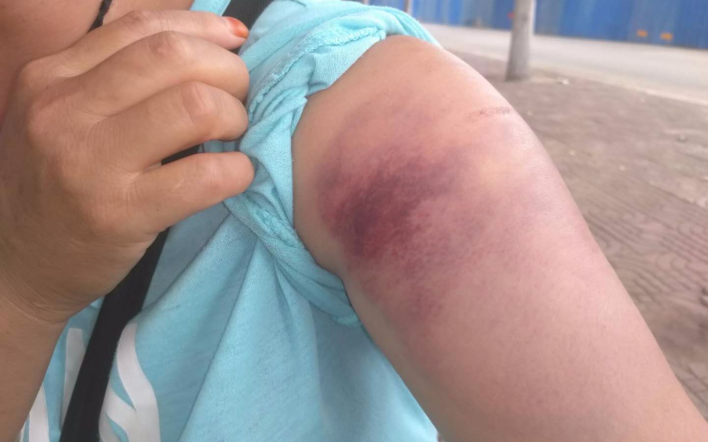 爆炸中,荣丽华的肩膀上留下一块淤青.