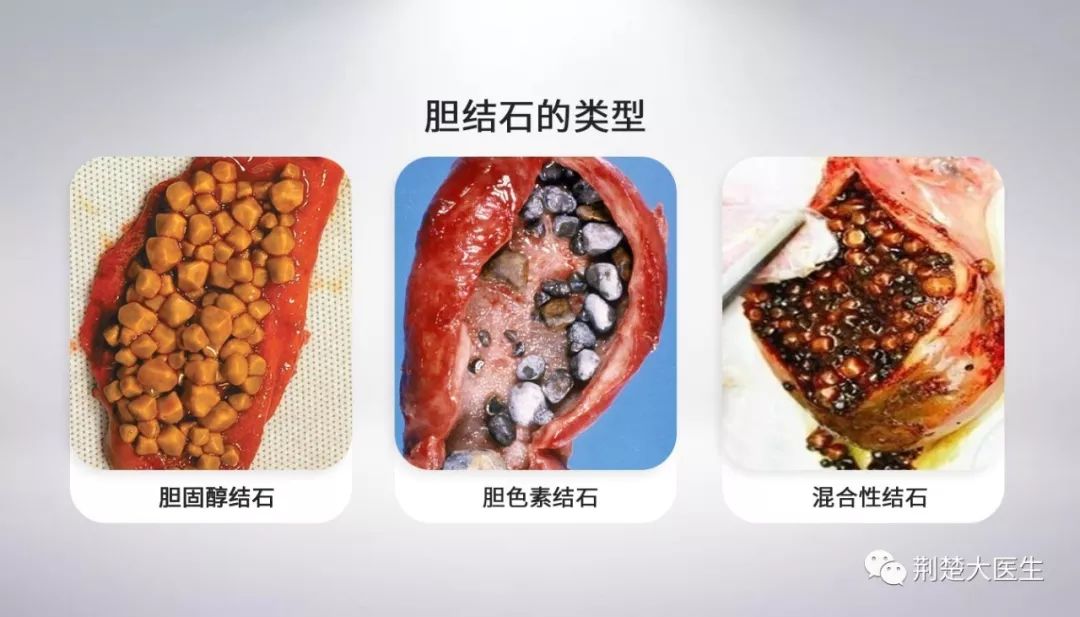 减肥吃素不吃早餐当心诱发胆结石多么痛的领悟