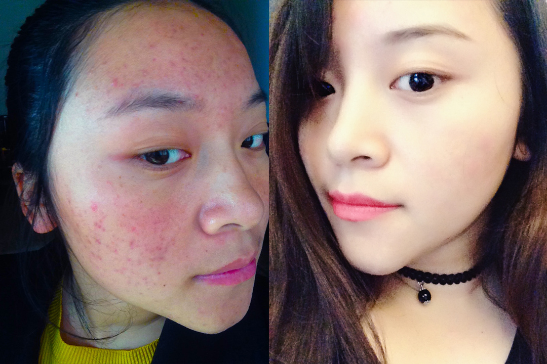 一个成功祛痘的案例和成功去痘印的方法女大学生的祛痘经历