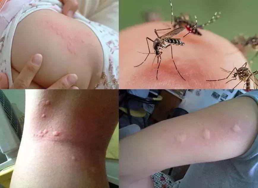 蚊子咬人图片 真实图片