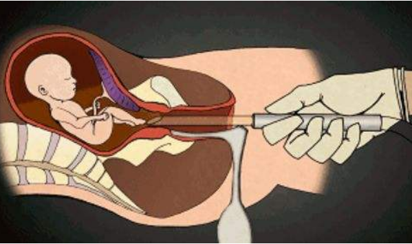 女人一生中不能超过几次流产?超过这个数得注意了_子宫