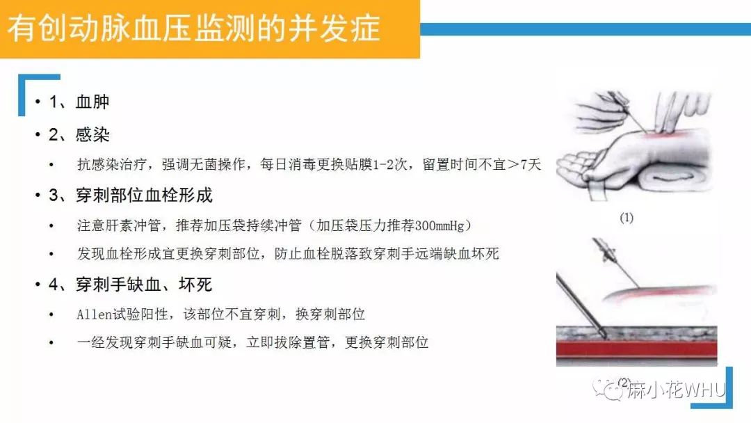 史上最详细的有创动脉血压波形解读来了彻底明白