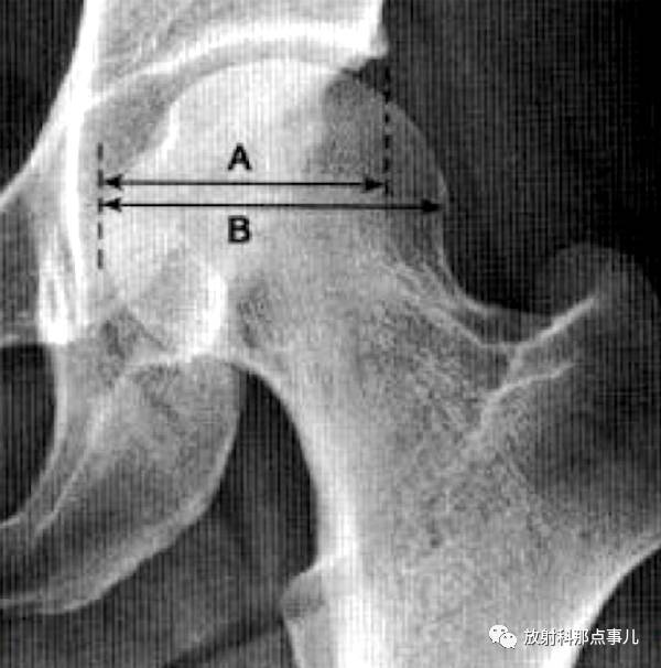 股骨头受髋臼覆盖部分的横径除以股骨头的横径,正常时应大于0.75.