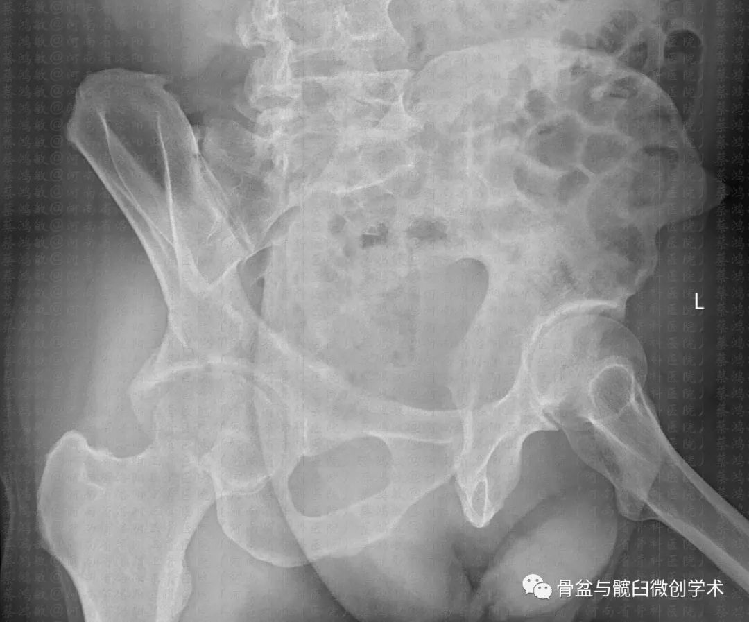 简单却不容小觑——髋臼后壁骨折的手术治疗_移位