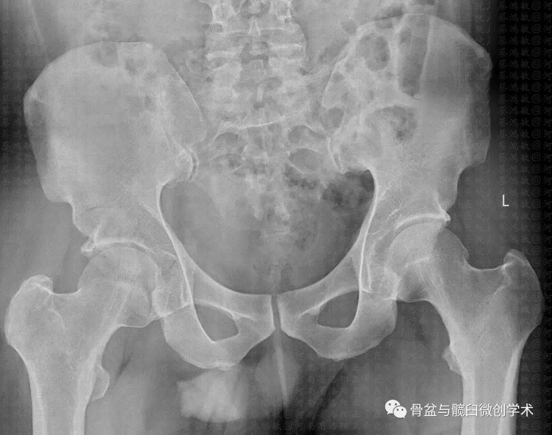 骨盆正位片顯示髂坐線(iliac-ischial line,iil),髂恥線(iliac-pectin