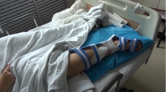 10岁女孩玩蹦床摔断腿 右腿被植入三颗钢钉 免责协议:由本人承担