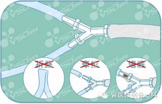 vsd引流术是什么图片