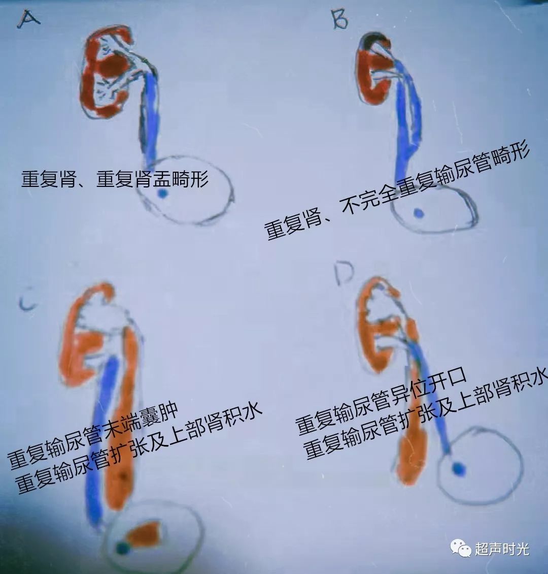 重复肾重复输尿管畸形并上部肾积水之我见