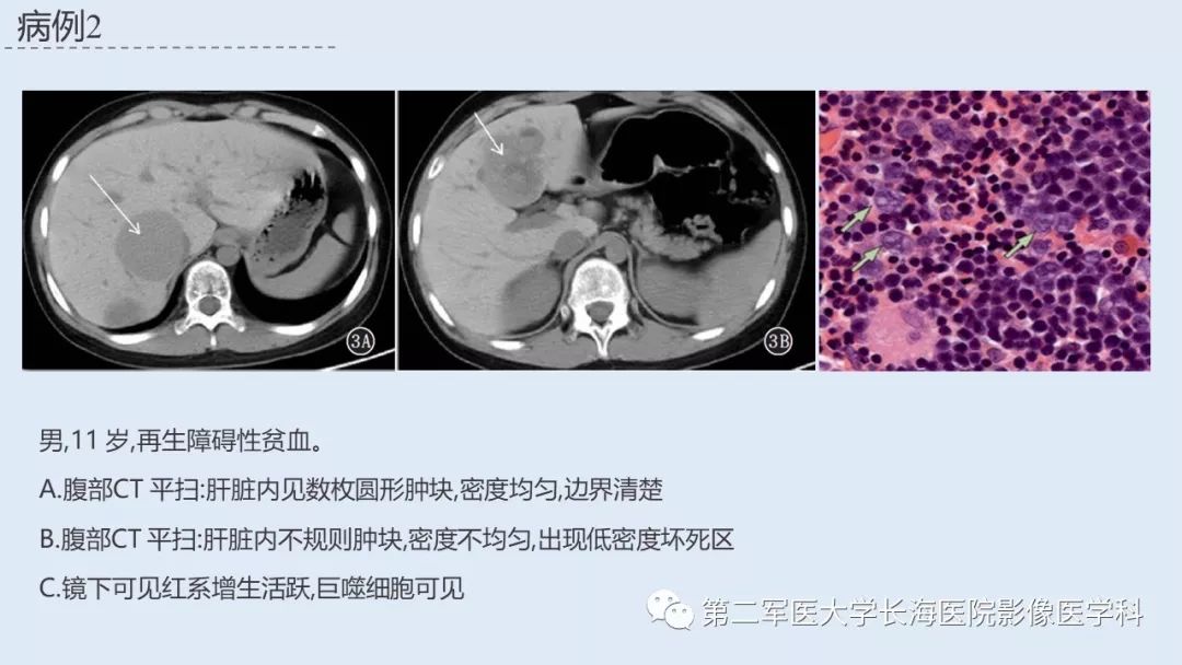 髓外造血的影像诊断