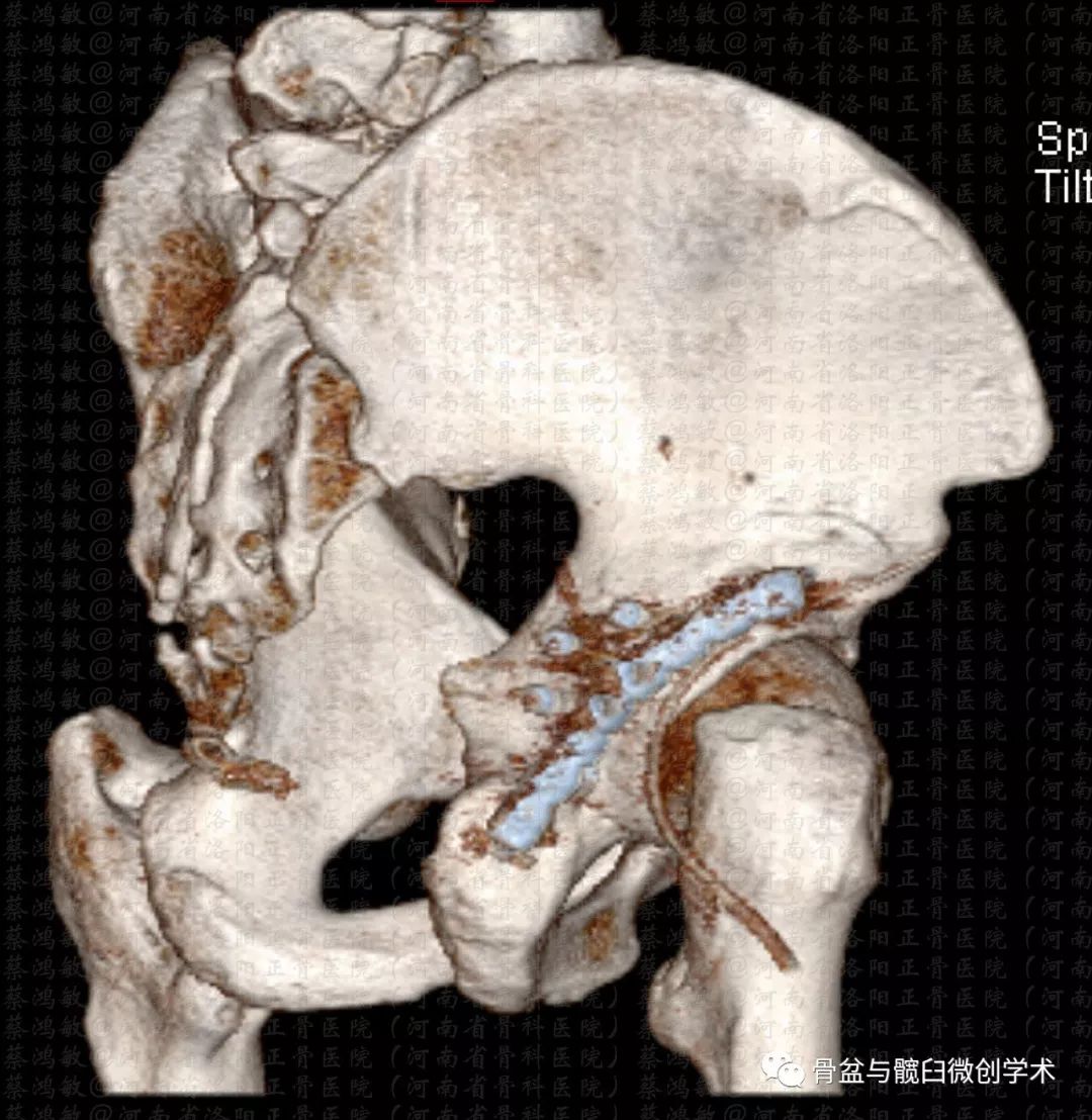 髋臼后壁图片