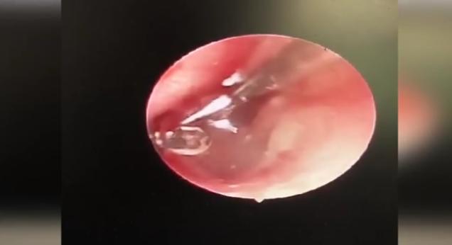 女童直喊耳朵疼已经水肿炎症到医院一看里面竟有2颗饰品小钻