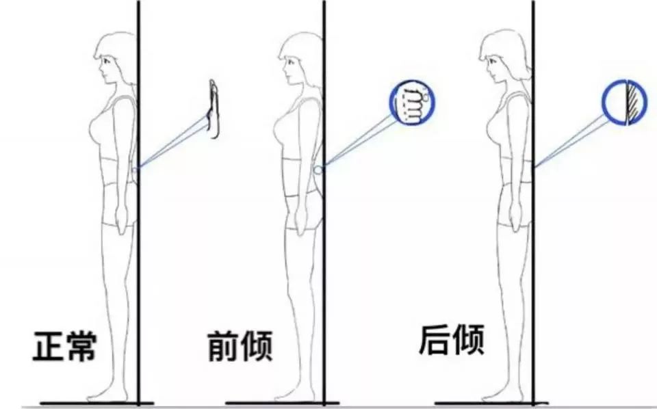 5s测出你有没有骨盆前倾30秒知识点