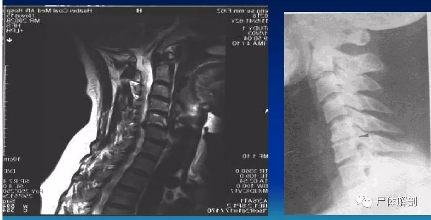 图解颈椎精细解剖颈椎病