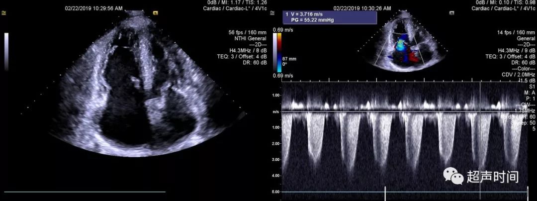 左室呈「d」型壓力負荷增加:肺心病圖 2 心尖四腔心切面顯示右心擴大