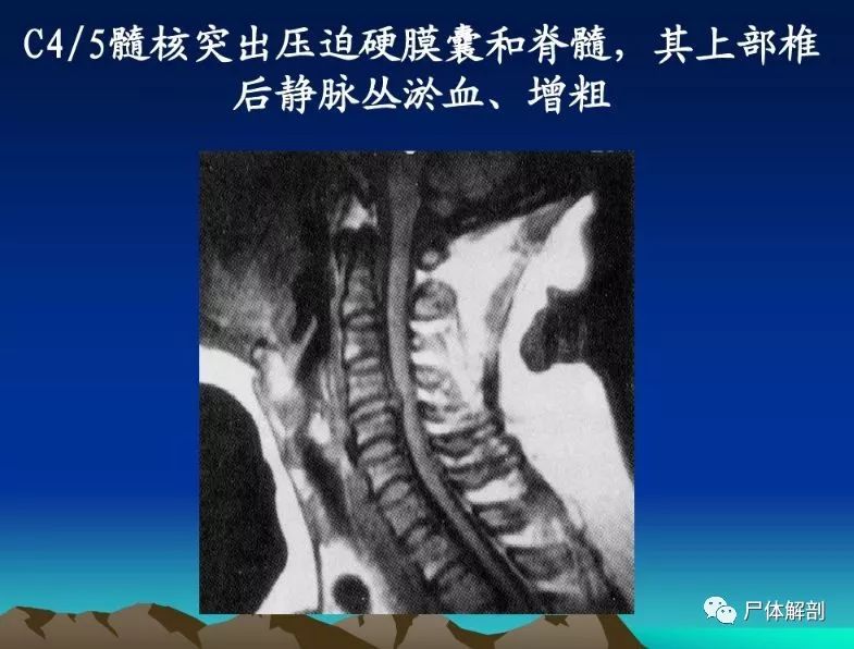 圖解頸椎精細解剖頸椎病