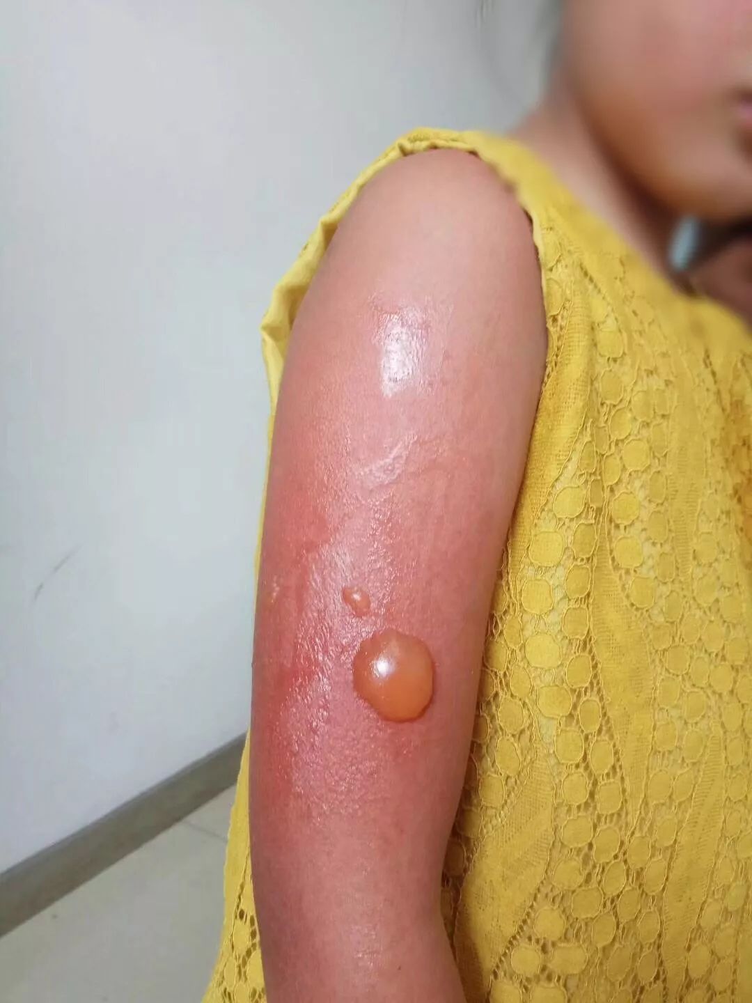 7岁女孩在外面玩一天胳膊起了大水泡!最近需要特别注意