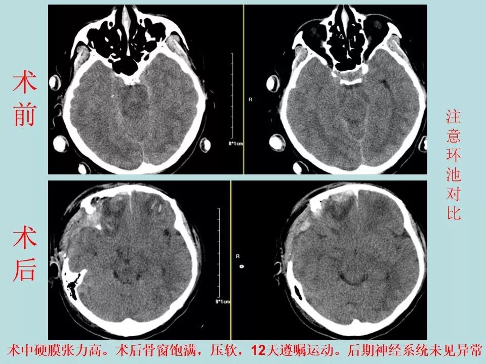 重型颅脑损伤患者环池影像改变的临床意义