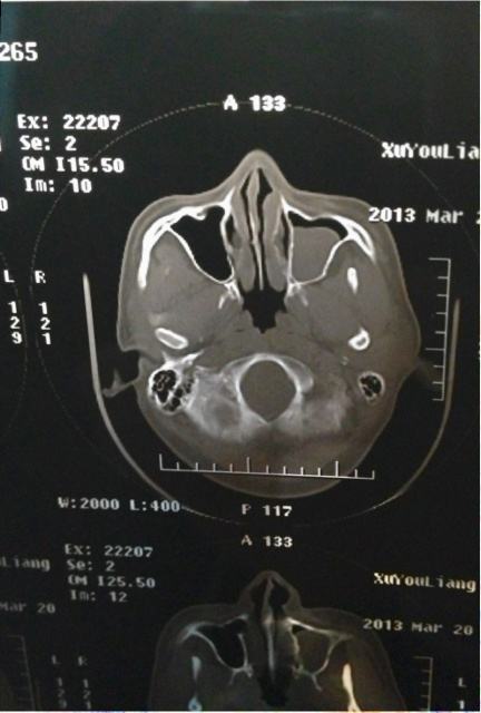 首大崔卫新鼻窦炎有多种不良症状预防鼻窦炎应注意什么