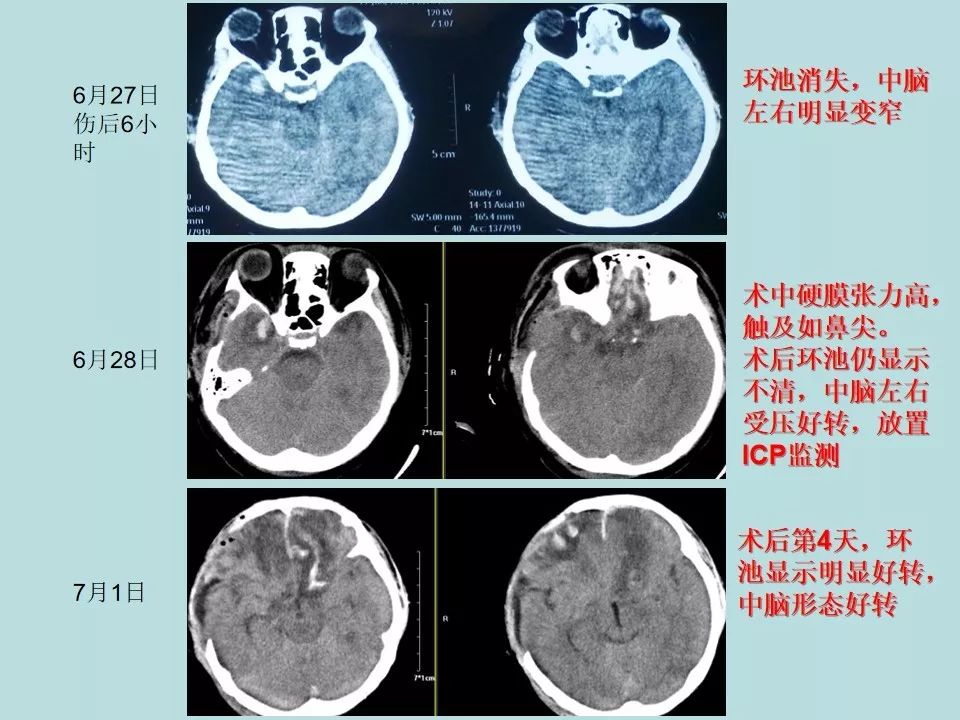 重型颅脑损伤患者环池影像改变的临床意义