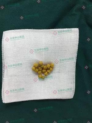 1颗结石不当回事 拖了8年后手术竟取出121颗胆结石