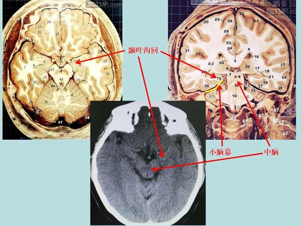 重型颅脑损伤患者环池影像改变的临床意义 