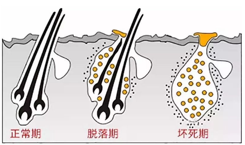 毛囊萎縮和毛囊閉合之間的真相就在這裡