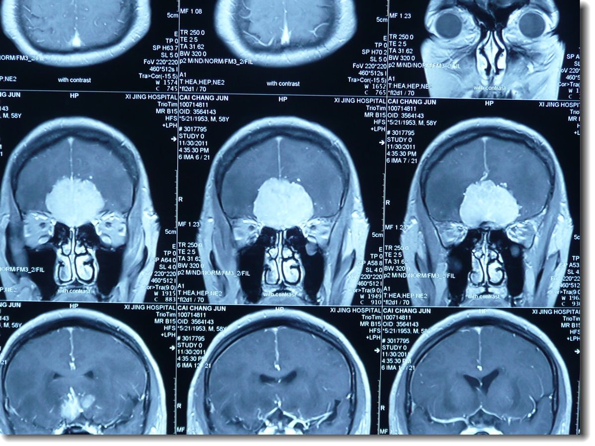 艰辛的历程:一位鞍结节脑膜瘤患者的治疗
