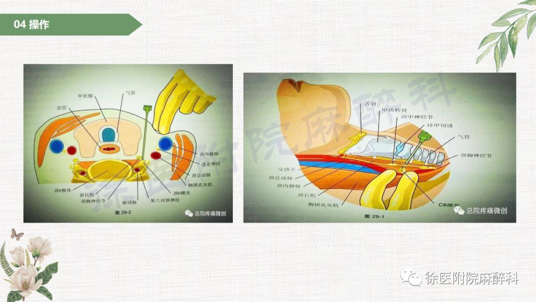 星状神经节阻滞术及临床进展