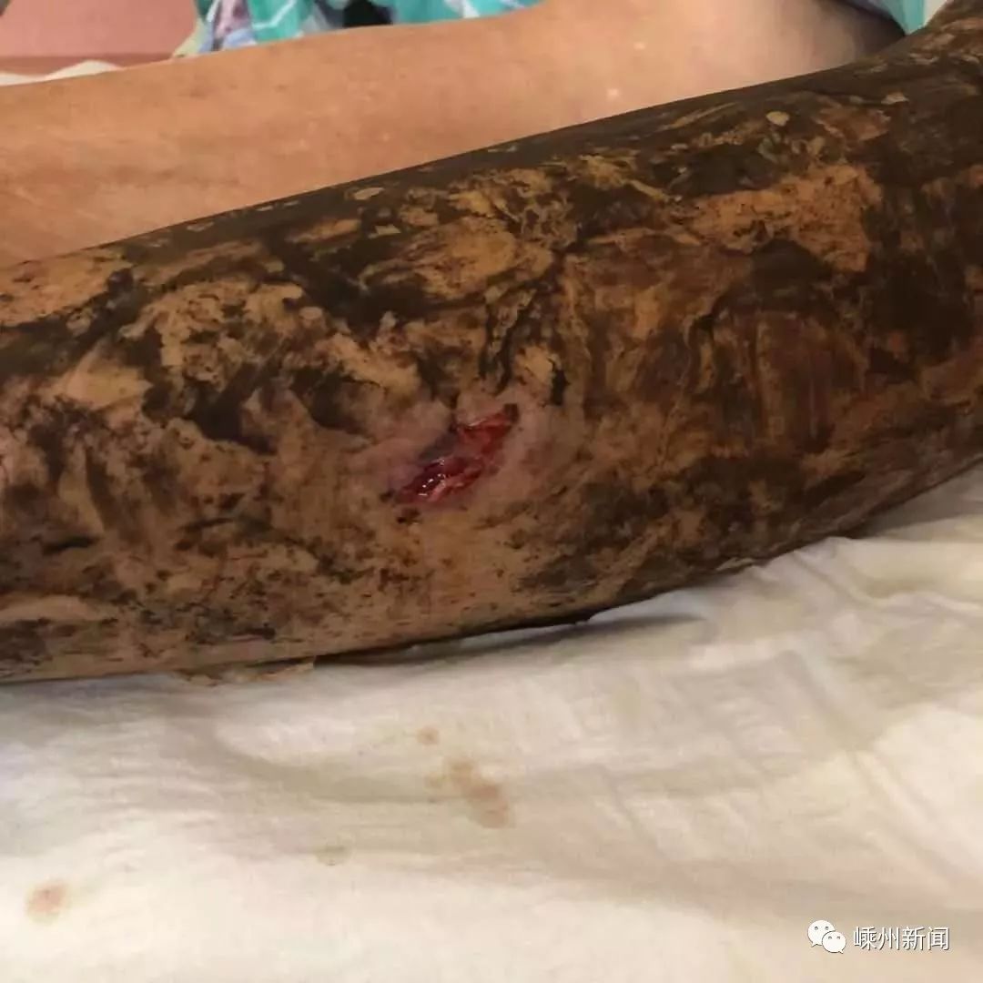 烙铁头蛇嵊州一男子晚上洗澡时被咬伤就因一个不起眼的小动作