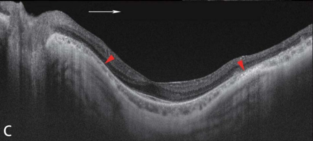 惟视资讯又要颠覆认知了后巩膜葡萄肿不一定是高度近视